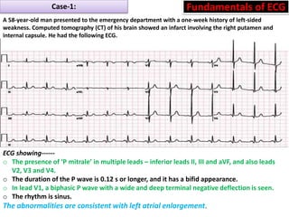 P wave abnormalities in ECG | PPSX