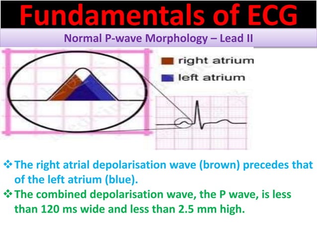 P Wave Abnormalities Ecg Ppt , P-wave, PR interval, PR segment ...