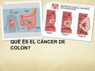 QUÈ ÉS EL CÀNCER DE
COLON?
 