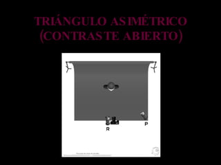 TRIÁNGULO ASIMÉTRICO (CONTRASTE ABIERTO) 