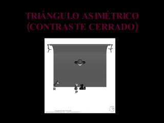 TRIÁNGULO ASIMÉTRICO (CONTRASTE CERRADO) 