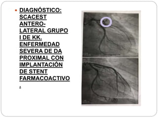  DIAGNÓSTICO:
SCACEST
ANTERO-
LATERAL GRUPO
I DE KK.
ENFERMEDAD
SEVERA DE DA
PROXIMAL CON
IMPLANTACIÓN
DE STENT
FARMACOACTIVO
.
 