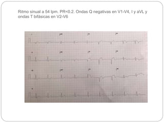 Ritmo sinual a 54 lpm. PR<0.2. Ondas Q negativas en V1-V4, I y aVL y
ondas T bifásicas en V2-V6
 