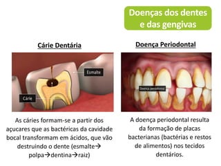 Doenças dos dentes
e das gengivas
As cáries formam-se a partir dos
açucares que as bactéricas da cavidade
bocal transformam em ácidos, que vão
destruindo o dente (esmalte
polpadentinaraiz)
A doença periodontal resulta
da formação de placas
bacterianas (bactérias e restos
de alimentos) nos tecidos
dentários.
Cárie Dentária Doença Periodontal
 