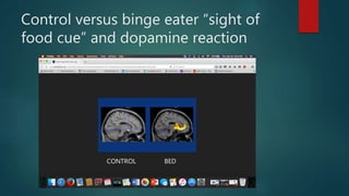 Control versus binge eater “sight of
food cue” and dopamine reaction
CONTROL BED
 