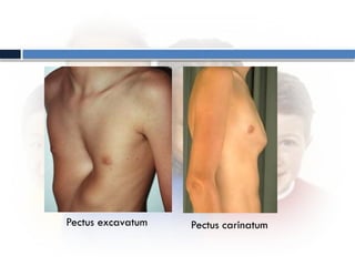 Pectus Types Pemeriksaan fisik anak, teknik dan pendekatan | PPTX