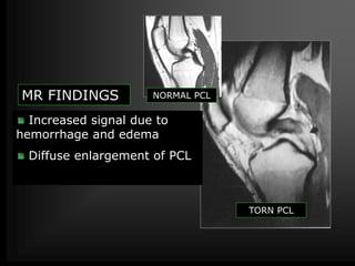 MRI of Knee joint-- hossam massoud | PPTX
