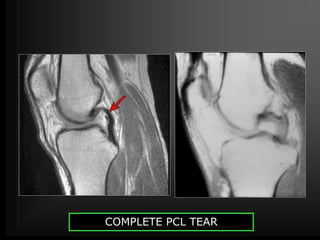 MRI of Knee joint-- hossam massoud | PPTX