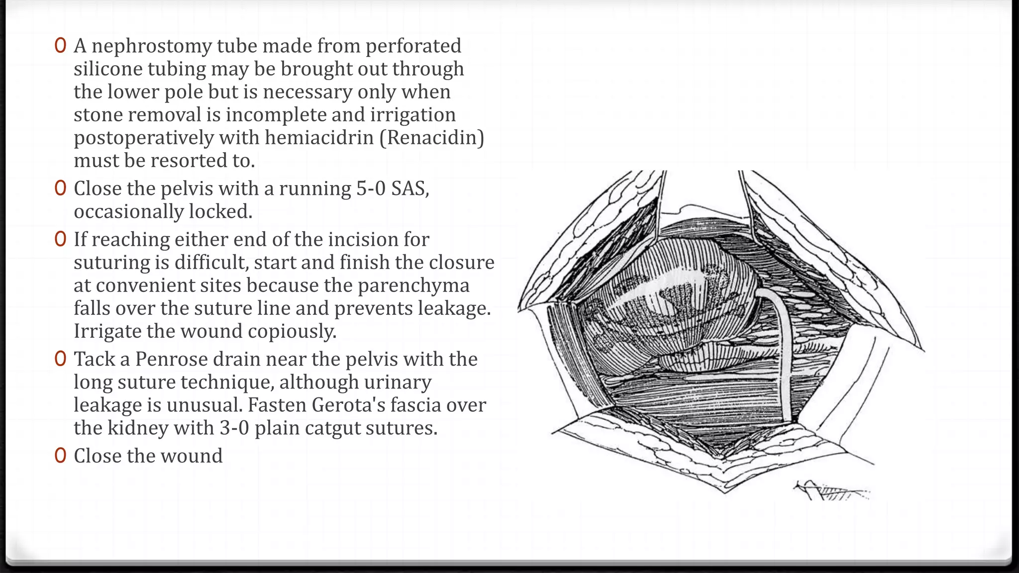 Open Pyelolithotomy | PPTX