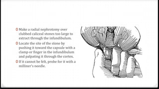 0 Make a radial nephrotomy over
clubbed caliceal stones too large to
extract through the infundibulum.
0 Locate the site of the stone by
pushing it toward the capsule with a
clamp or finger in the infundibulum
and palpating it through the cortex.
0 If it cannot be felt, probe for it with a
milliner's needle.
 