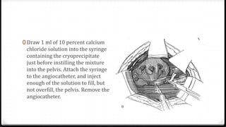 0 Draw 1 ml of 10 percent calcium
chloride solution into the syringe
containing the cryoprecipitate
just before instilling the mixture
into the pelvis. Attach the syringe
to the angiocatheter, and inject
enough of the solution to fill, but
not overfill, the pelvis. Remove the
angiocatheter.
 