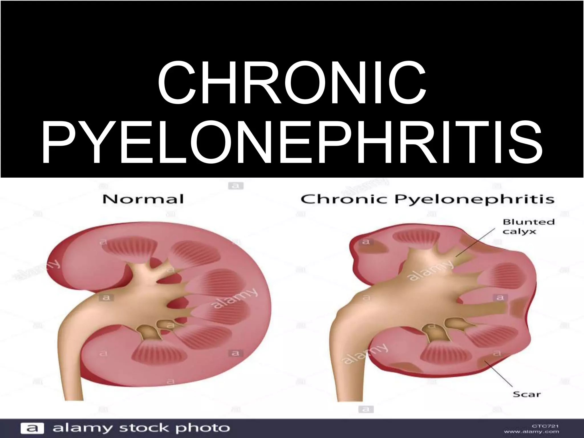 CHRONIC
PYELONEPHRITIS
 