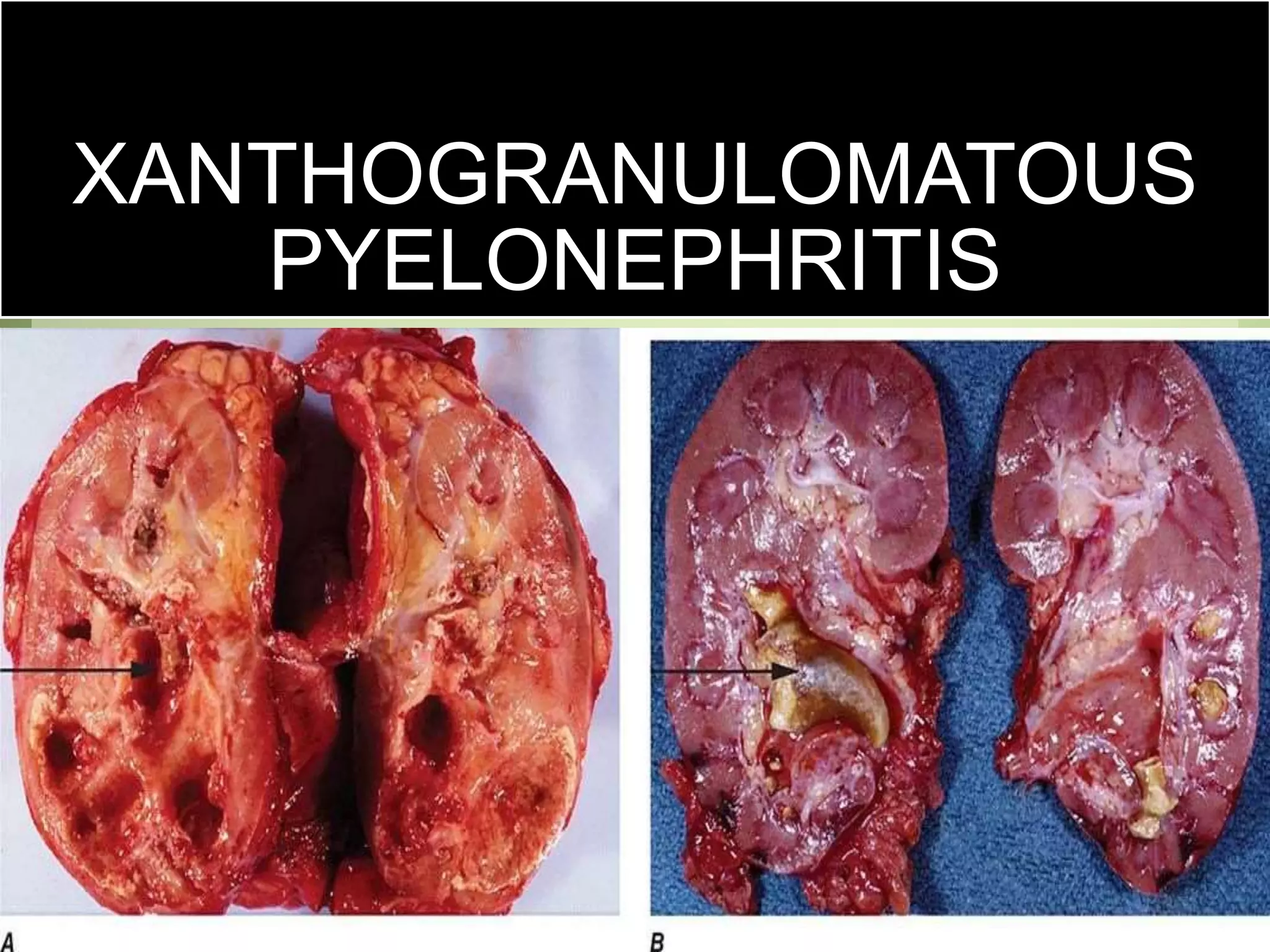 XANTHOGRANULOMATOUS
PYELONEPHRITIS
 