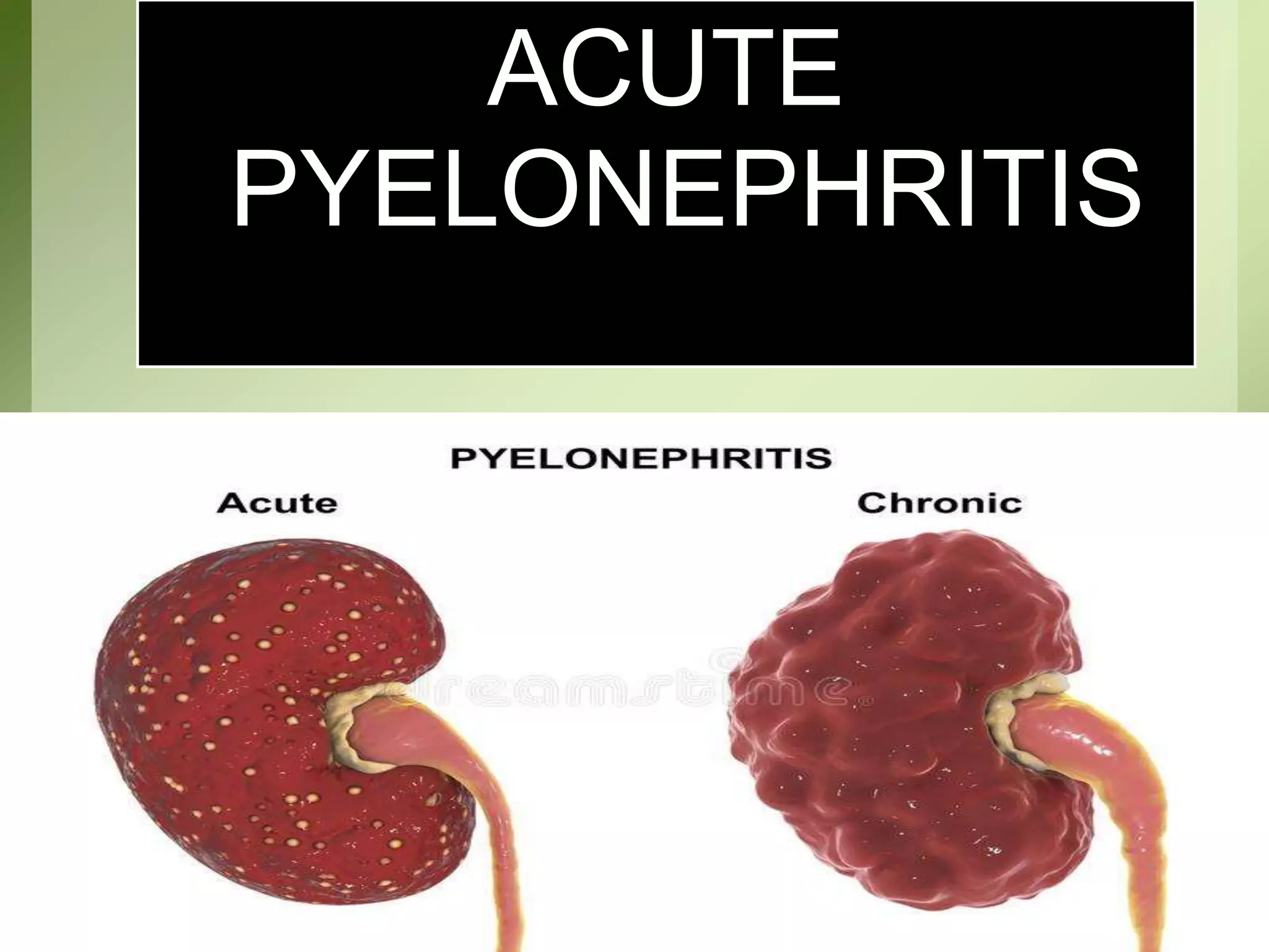 ACUTE
PYELONEPHRITIS
 