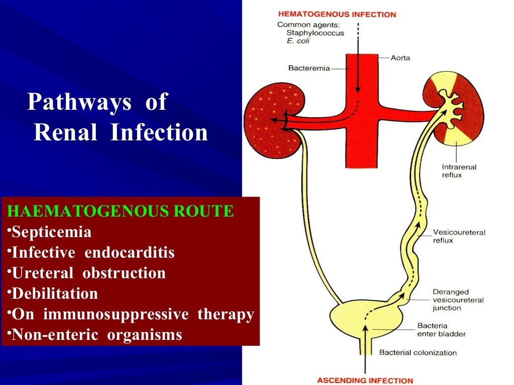Pyelonephritis csbrp