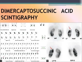 DIMERCAPTOSUCCINIC ACID
SCINTIGRAPHY
 