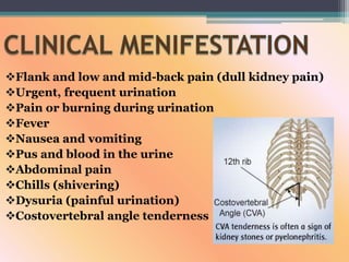 Flank and low and mid-back pain (dull kidney pain)
Urgent, frequent urination
Pain or burning during urination
Fever
Nausea and vomiting
Pus and blood in the urine
Abdominal pain
Chills (shivering)
Dysuria (painful urination)
Costovertebral angle tenderness
 