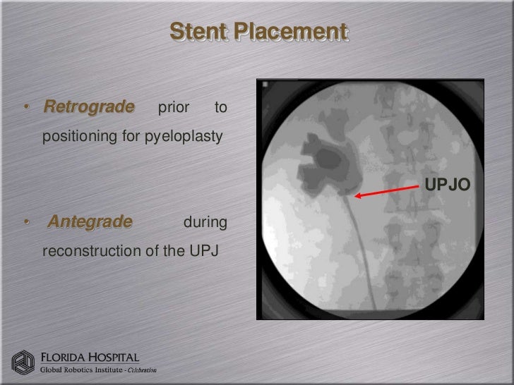 RoboticAssisted Pyeloplasty