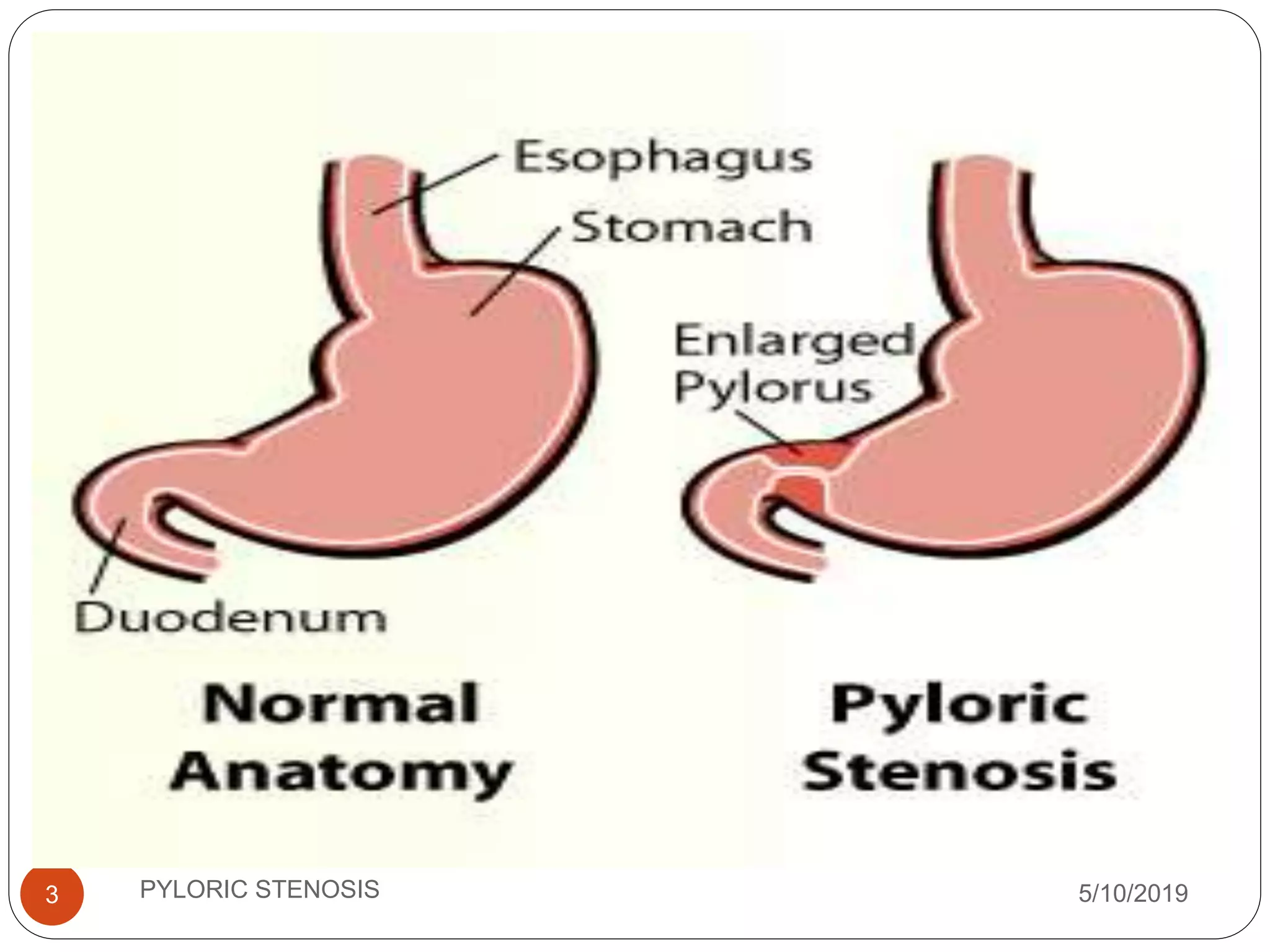 Pyloric Stenosis PPTX Digestive Disorders Diseases And Conditions