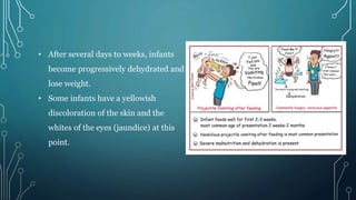 • After several days to weeks, infants
become progressively dehydrated and
lose weight.
• Some infants have a yellowish
discoloration of the skin and the
whites of the eyes (jaundice) at this
point.
 