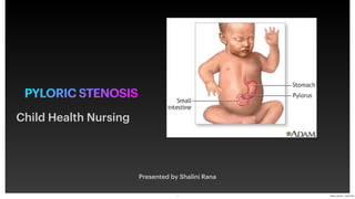 PYLORIC STENOSIS
Presented by Shalini Rana
Child Health Nursing
1 Pyloric stenosis - 3 April 2024
 
