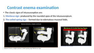 Spring Sign Intersusception PYLORIC STENOSIS AND ISS Surgery essential.pptx