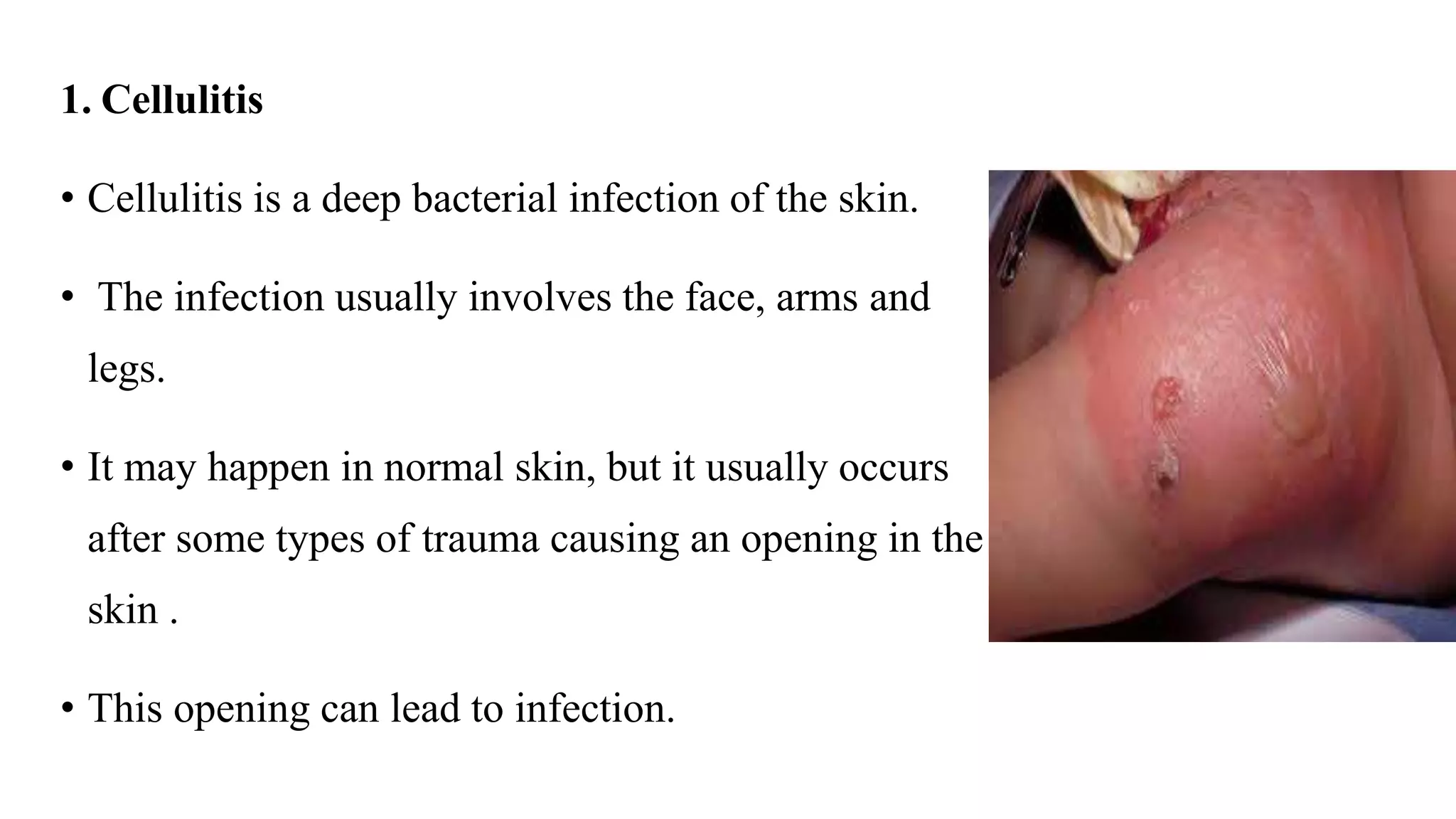 1. Cellulitis
• Cellulitis is a deep bacterial infection of the skin.
• The infection usually involves the face, arms and
legs.
• It may happen in normal skin, but it usually occurs
after some types of trauma causing an opening in the
skin .
• This opening can lead to infection.
 