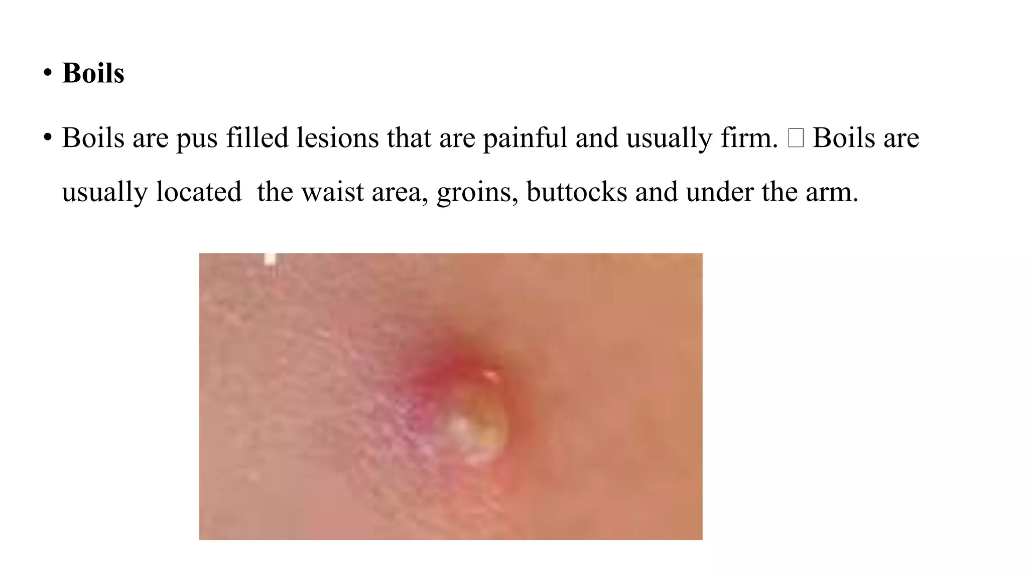• Boils
• Boils are pus filled lesions that are painful and usually firm.  Boils are
usually located the waist area, groins, buttocks and under the arm.
 