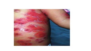 Pyoderma Diffuse pyoderma.pptx
