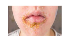 Health Pyoderma pyoderma.pptx