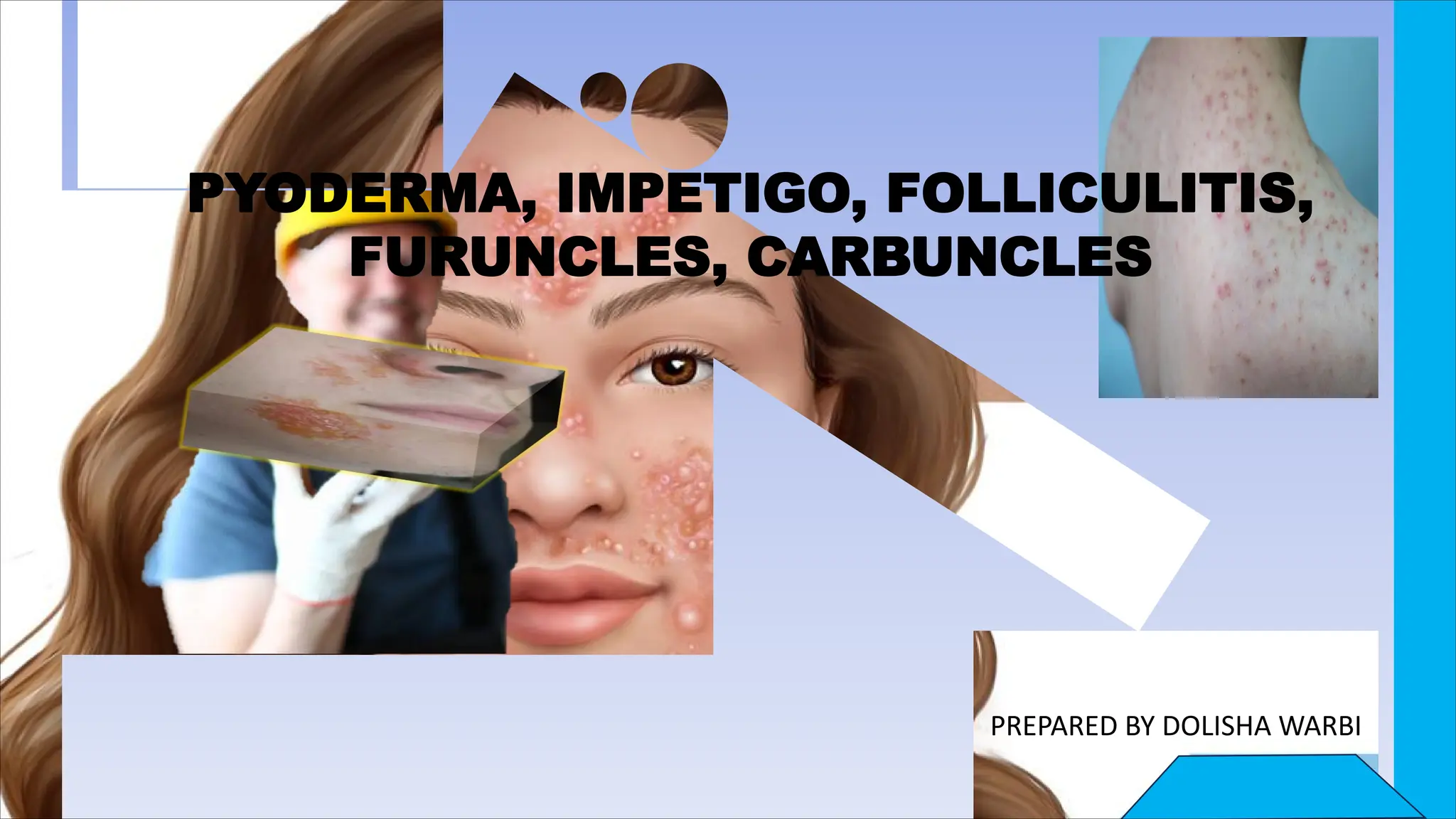 .
PREPARED BY DOLISHA WARBI
PYODERMA, IMPETIGO, FOLLICULITIS,
FURUNCLES, CARBUNCLES
 