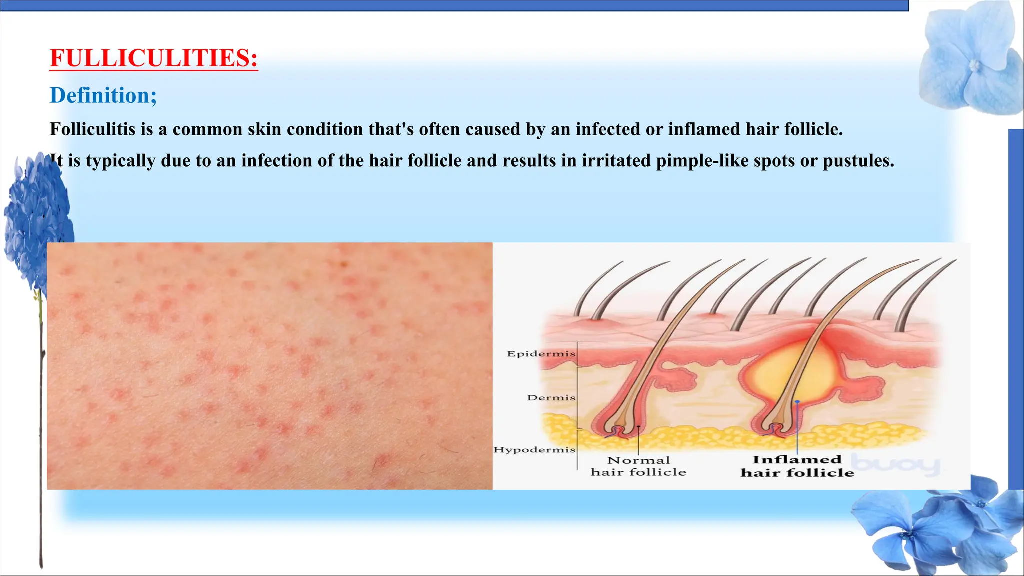 FULLICULITIES:
Definition;
Folliculitis is a common skin condition that's often caused by an infected or inflamed hair follicle.
It is typically due to an infection of the hair follicle and results in irritated pimple-like spots or pustules.
 