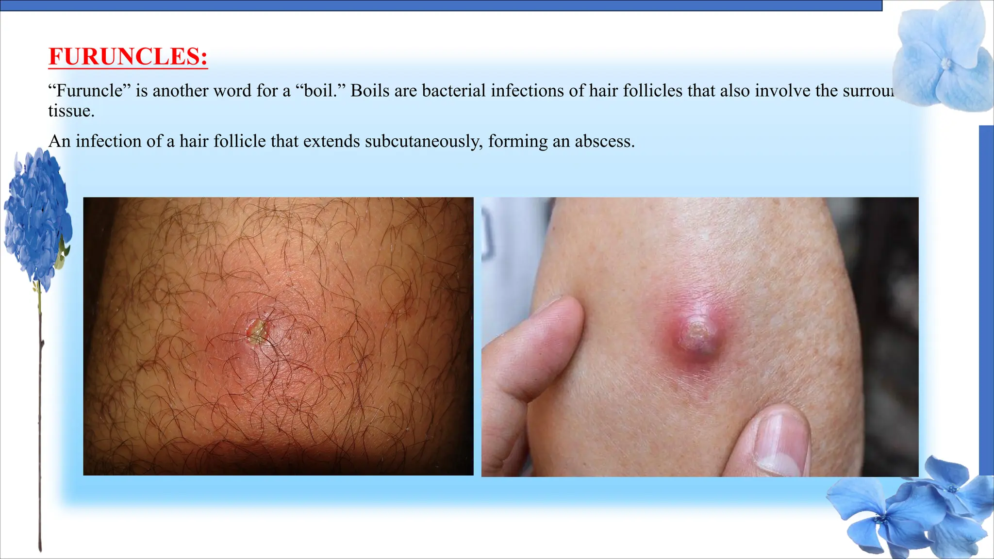 FURUNCLES:
“Furuncle” is another word for a “boil.” Boils are bacterial infections of hair follicles that also involve the surrounding
tissue.
An infection of a hair follicle that extends subcutaneously, forming an abscess.
 