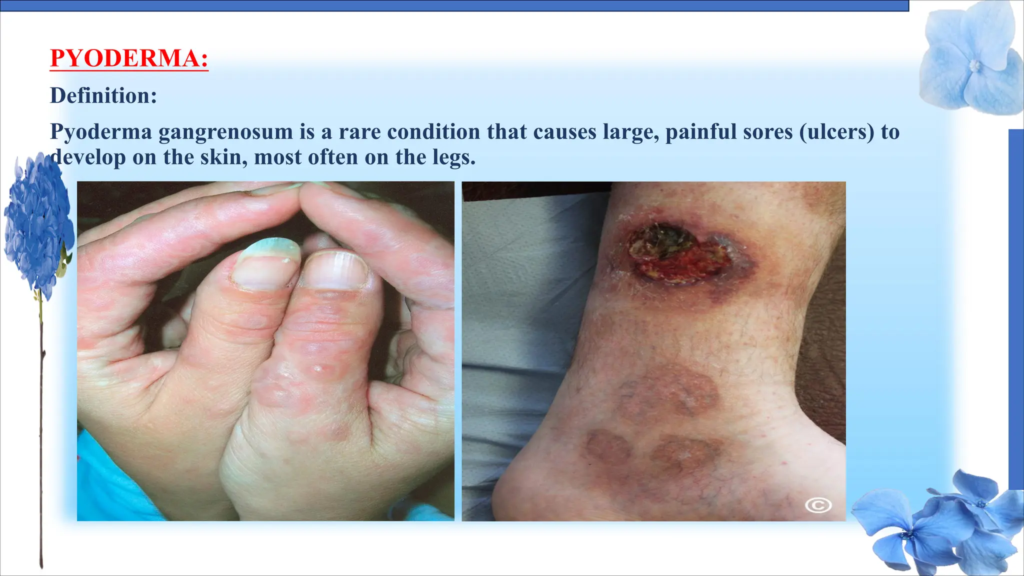 PYODERMA:
Definition:
Pyoderma gangrenosum is a rare condition that causes large, painful sores (ulcers) to
develop on the skin, most often on the legs.
 
