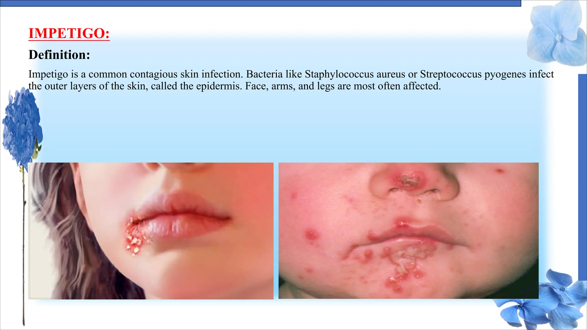IMPETIGO:
Definition:
Impetigo is a common contagious skin infection. Bacteria like Staphylococcus aureus or Streptococcus pyogenes infect
the outer layers of the skin, called the epidermis. Face, arms, and legs are most often affected.
 