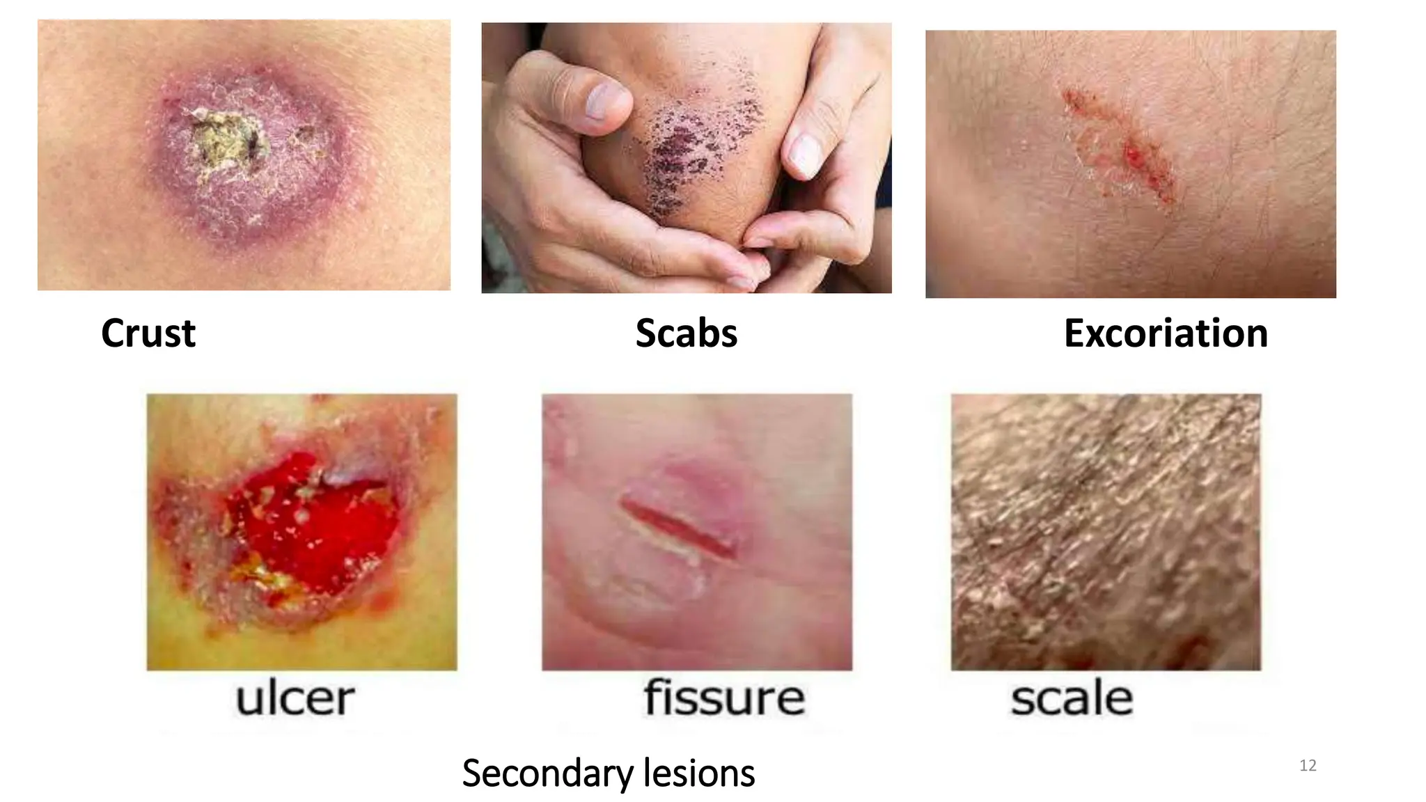 Secondary lesions
Crust Scabs Excoriation
12
 