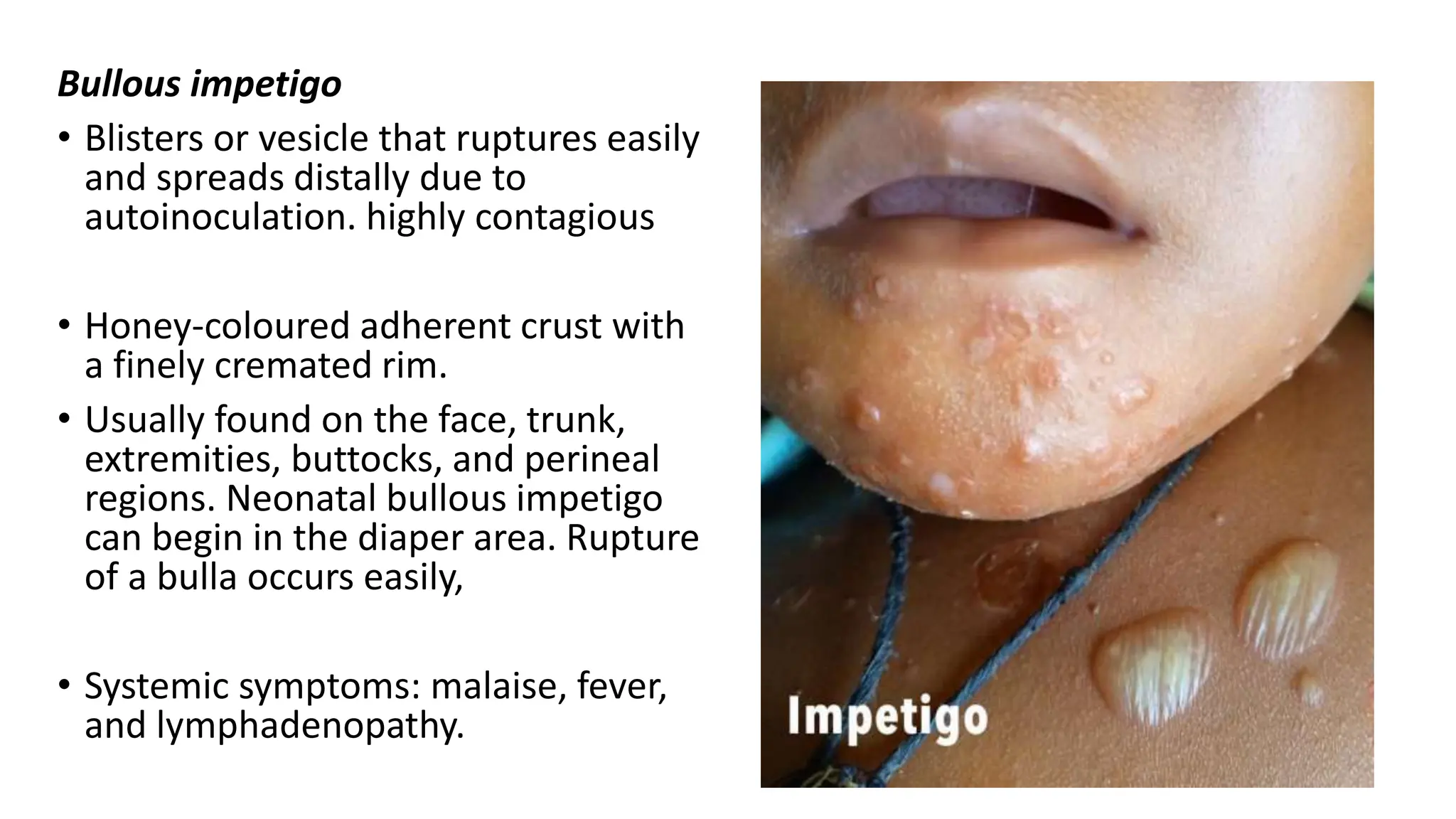 Bullous impetigo
• Blisters or vesicle that ruptures easily
and spreads distally due to
autoinoculation. highly contagious
• Honey-coloured adherent crust with
a finely cremated rim.
• Usually found on the face, trunk,
extremities, buttocks, and perineal
regions. Neonatal bullous impetigo
can begin in the diaper area. Rupture
of a bulla occurs easily,
• Systemic symptoms: malaise, fever,
and lymphadenopathy.
15
 
