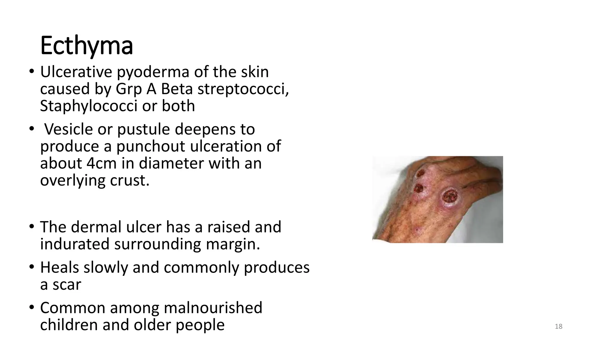 Ecthyma
• Ulcerative pyoderma of the skin
caused by Grp A Beta streptococci,
Staphylococci or both
• Vesicle or pustule deepens to
produce a punchout ulceration of
about 4cm in diameter with an
overlying crust.
• The dermal ulcer has a raised and
indurated surrounding margin.
• Heals slowly and commonly produces
a scar
• Common among malnourished
children and older people 18
 