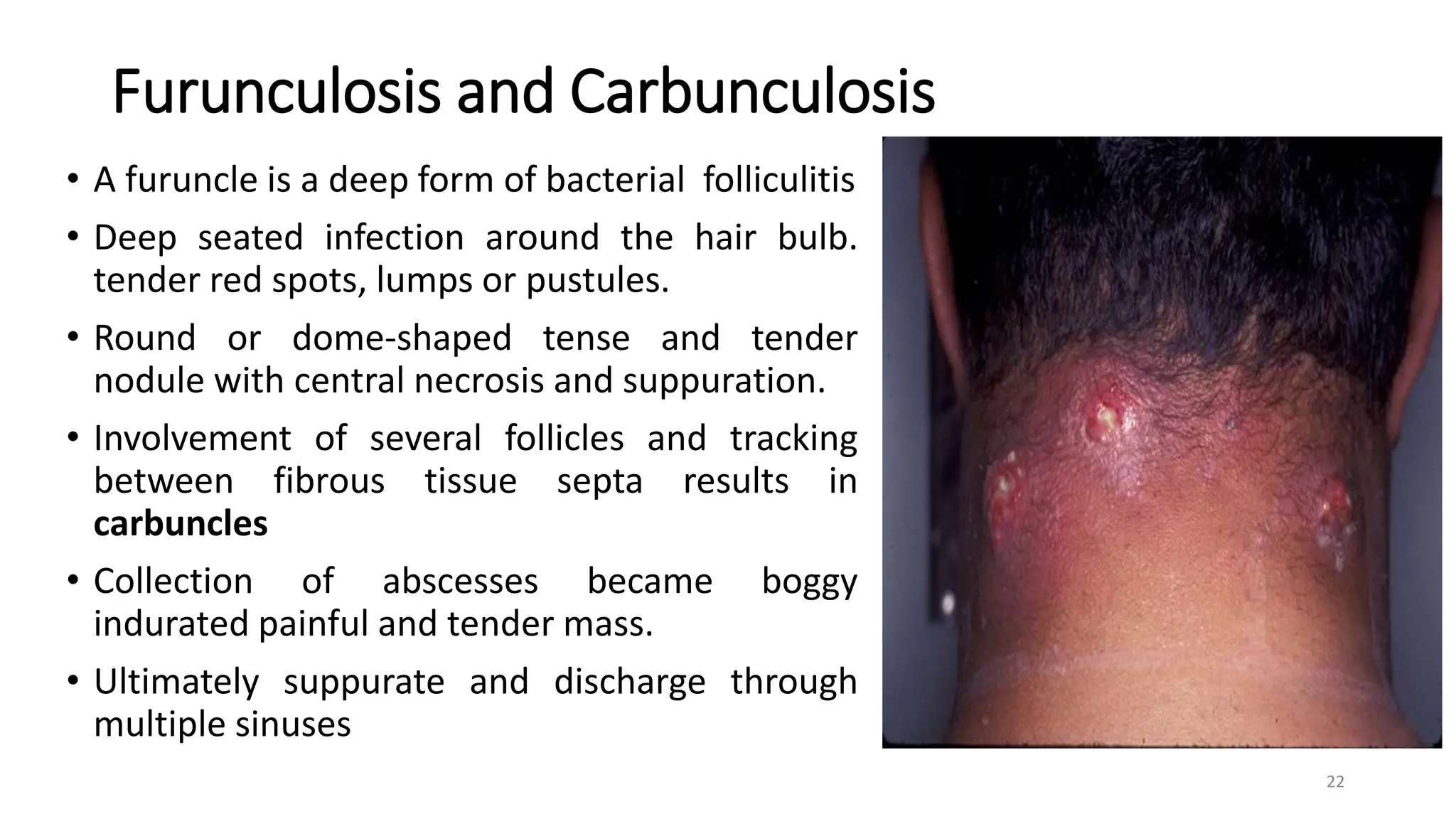 Furunculosis and Carbunculosis
• A furuncle is a deep form of bacterial folliculitis
• Deep seated infection around the hair bulb.
tender red spots, lumps or pustules.
• Round or dome-shaped tense and tender
nodule with central necrosis and suppuration.
• Involvement of several follicles and tracking
between fibrous tissue septa results in
carbuncles
• Collection of abscesses became boggy
indurated painful and tender mass.
• Ultimately suppurate and discharge through
multiple sinuses
22
 