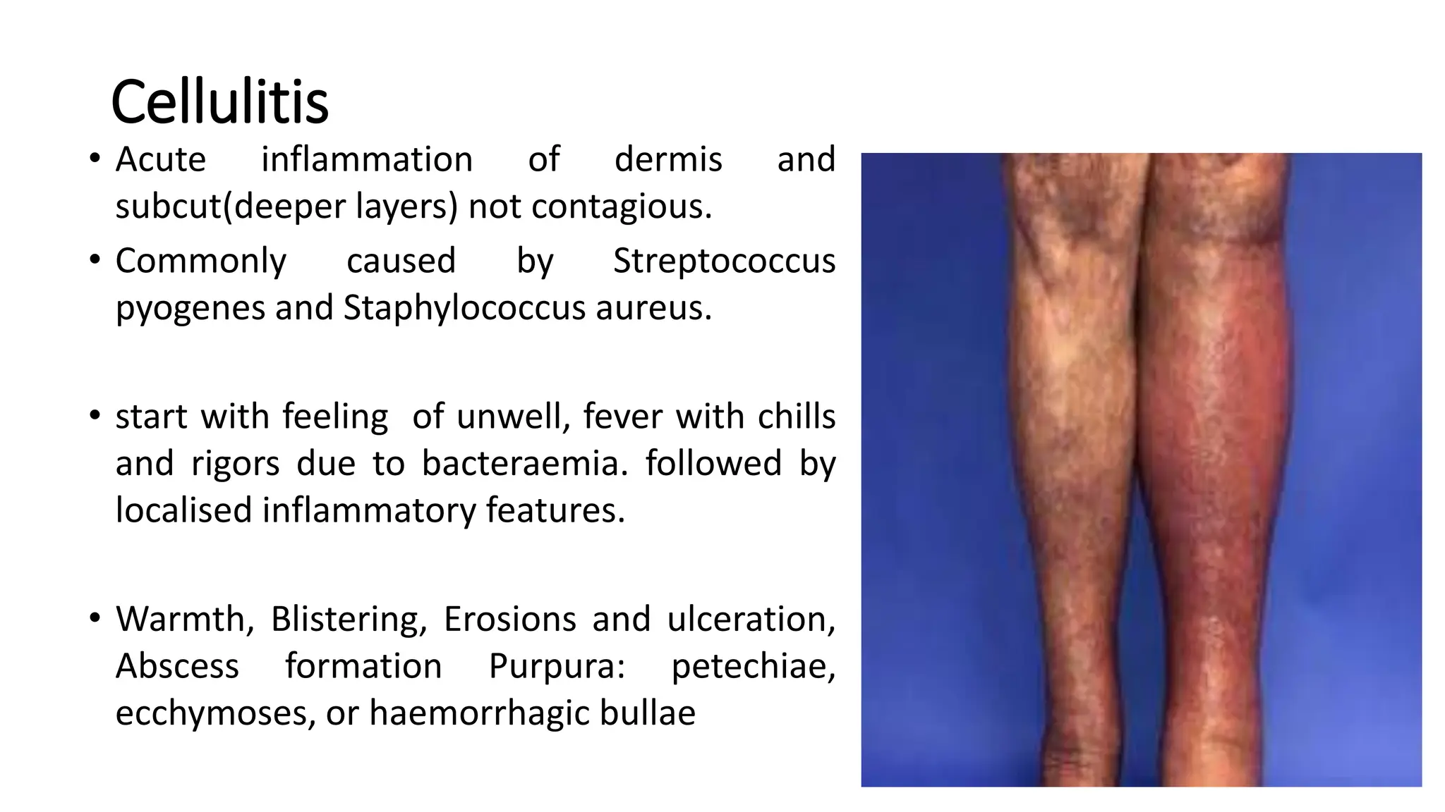 Cellulitis
• Acute inflammation of dermis and
subcut(deeper layers) not contagious.
• Commonly caused by Streptococcus
pyogenes and Staphylococcus aureus.
• start with feeling of unwell, fever with chills
and rigors due to bacteraemia. followed by
localised inflammatory features.
• Warmth, Blistering, Erosions and ulceration,
Abscess formation Purpura: petechiae,
ecchymoses, or haemorrhagic bullae
24
 