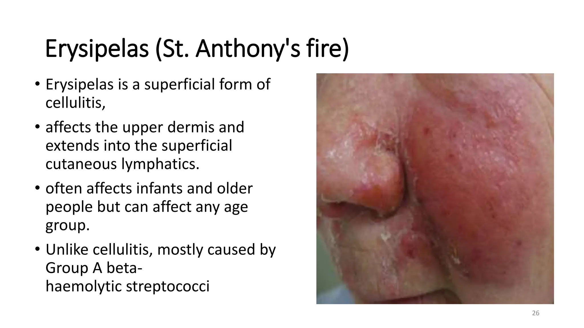 Erysipelas (St. Anthony's fire)
• Erysipelas is a superficial form of
cellulitis,
• affects the upper dermis and
extends into the superficial
cutaneous lymphatics.
• often affects infants and older
people but can affect any age
group.
• Unlike cellulitis, mostly caused by
Group A beta-
haemolytic streptococci
26
 