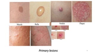 Primary lesions 10
 