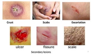 Secondary lesions
Crust Scabs Excoriation
12
 