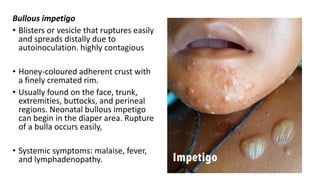 Bullous impetigo
• Blisters or vesicle that ruptures easily
and spreads distally due to
autoinoculation. highly contagious
• Honey-coloured adherent crust with
a finely cremated rim.
• Usually found on the face, trunk,
extremities, buttocks, and perineal
regions. Neonatal bullous impetigo
can begin in the diaper area. Rupture
of a bulla occurs easily,
• Systemic symptoms: malaise, fever,
and lymphadenopathy.
15
 