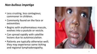 Non-bullous impetigo
• Less crusting, less contagious;
commoner in children.
• Commonly found on the face or
extremities
• Begins with erythematous macule,
evolves into a pustule or vesicle.
• Can spread rapidly with satellite
lesions due to autoinoculation.
• Patients are typically otherwise well;
they may experience some itching
and regional lymphadenopathy.
16
 
