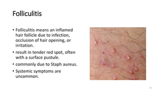 Folliculitis
• Folliculitis means an inflamed
hair follicle due to infection,
occlusion of hair opening, or
irritation.
• result in tender red spot, often
with a surface pustule.
• commonly due to Staph aureus.
• Systemic symptoms are
uncommon.
20
 