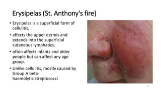 Erysipelas (St. Anthony's fire)
• Erysipelas is a superficial form of
cellulitis,
• affects the upper dermis and
extends into the superficial
cutaneous lymphatics.
• often affects infants and older
people but can affect any age
group.
• Unlike cellulitis, mostly caused by
Group A beta-
haemolytic streptococci
26
 