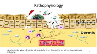 Pathophysiology
A schematic view of bacterial skin infection, derived from a loss in epidermis
integrity. 8
 