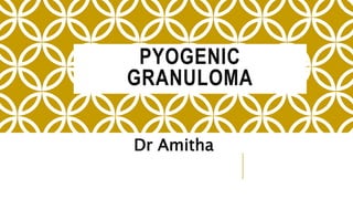 PYOGENIC
GRANULOMA
Dr Amitha
 