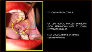 Contoso
S u i t e s
YELLOWISH PINK IN COLOUR
SEMI-CIRCULAR SHAPE WITH WELL
DEFINED MARGINS
ON LEFT BUCCAL MUCOSA EXTENDING
FROM RETROMOLAR AREA TO LOWER
LEFT SECOND MOLAR
 